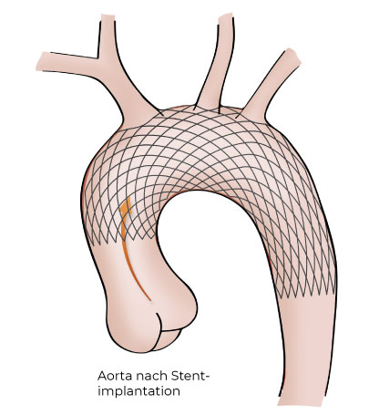 Aortic-Stent_Illustration_3